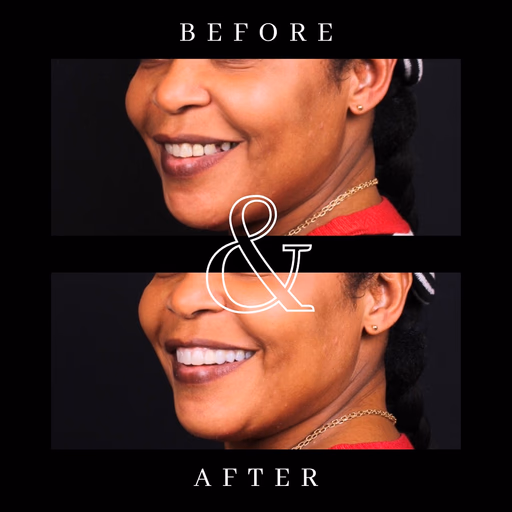 Before and after smile transformation 2