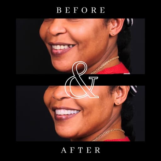 Before and after smile transformation 2